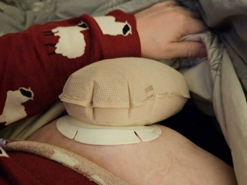 A close up of a stoma bag balooning, attached to a stomach