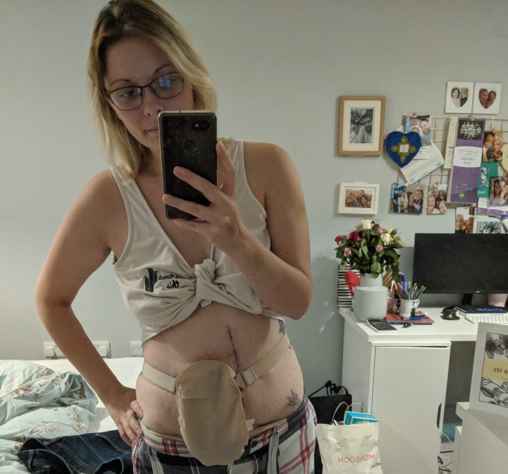 A woman takes a mirror selfie, showing her ostomy bag under he clothes.