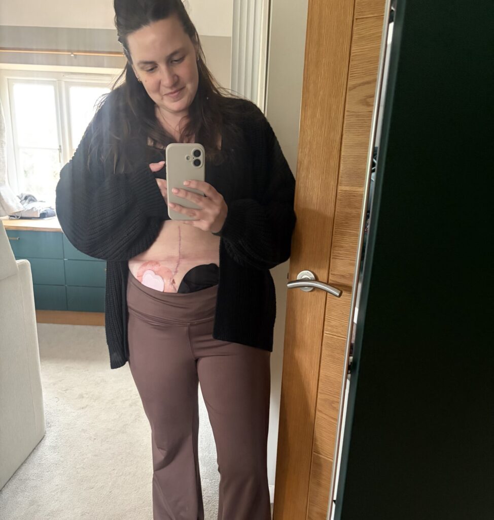 A brunette woman lifts her shirt to show her ostomy bag