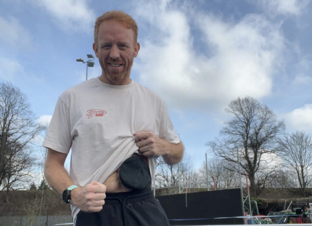 A red-haired man lifts his white shirt to reveal his ostomy bag